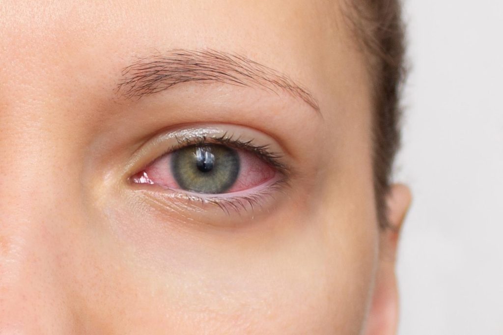 Ochi uscați – ce este xeroftalmia și cum o poți preveni natural pentru un confort ocular optim?