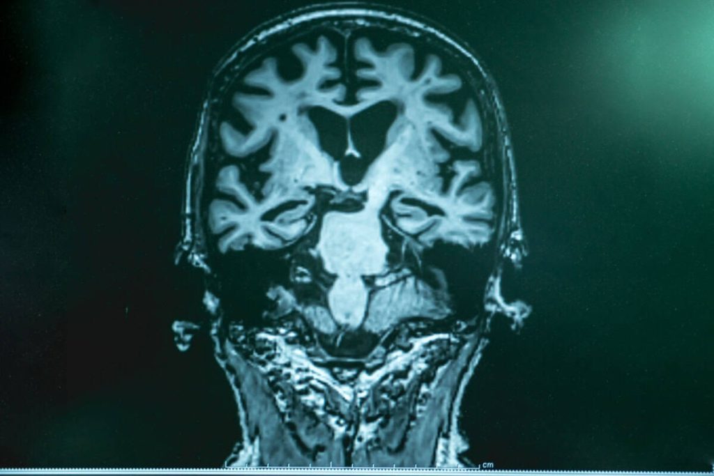 Ce vitamine se recomandă pentru atrofie cerebrală difuză?