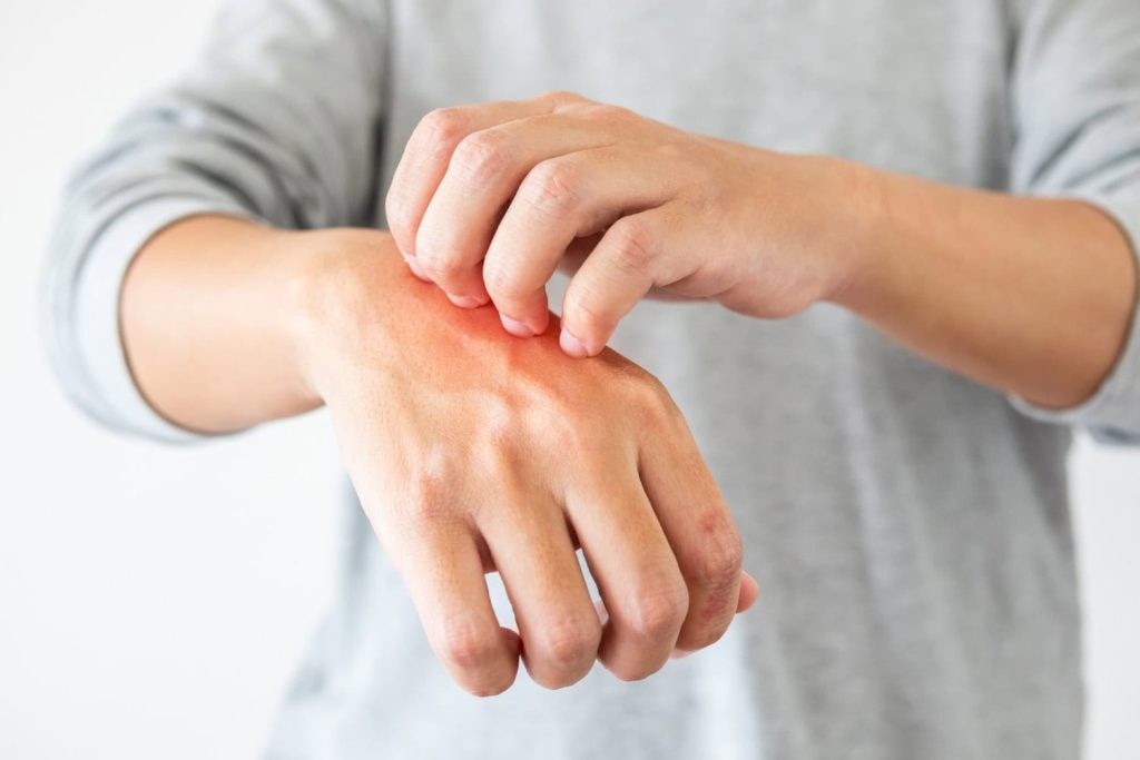 Regim alimentar pentru dermatita atopică – remedii blânde pentru o piele sănătoasă