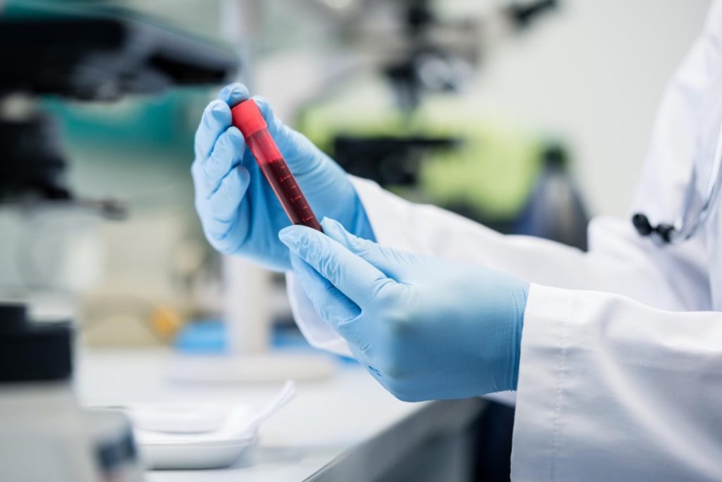 Sângele îngroșat – cauze, simptome, tratament și exemple de medicamente și alimente care favorizează subțierea sângelui