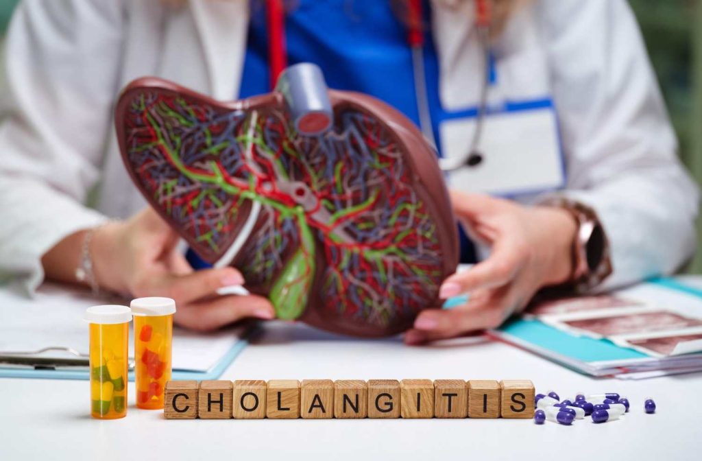 Colangita – simptome, cauze și tratament pentru inflamația căilor biliare