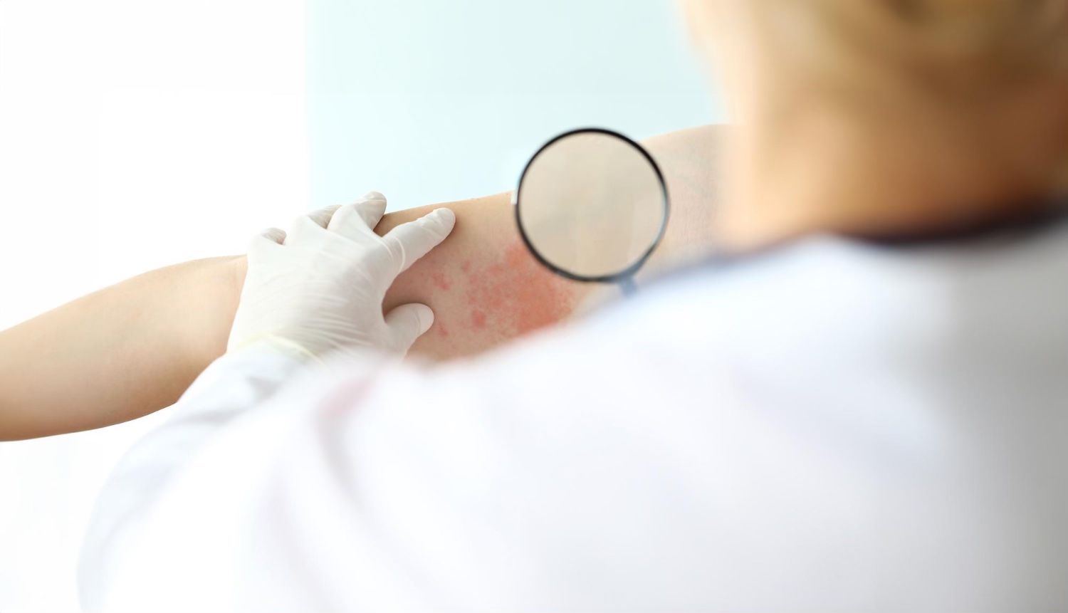 Pitiriazisul rozat Gibert (medic dermatolog care verifica bratul unui pacient, lupa, pete rosii pe piele)