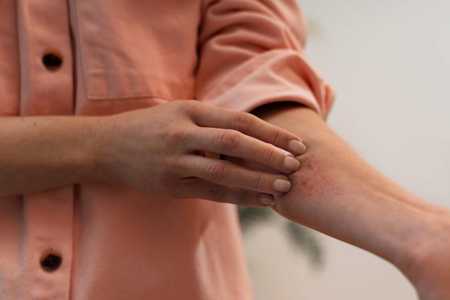 1. dermatoza maini, alergie
