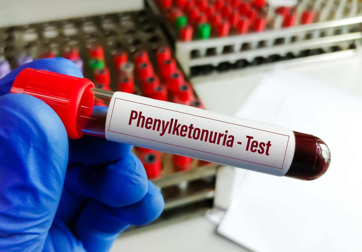 1. fenilcetonurie test de sange