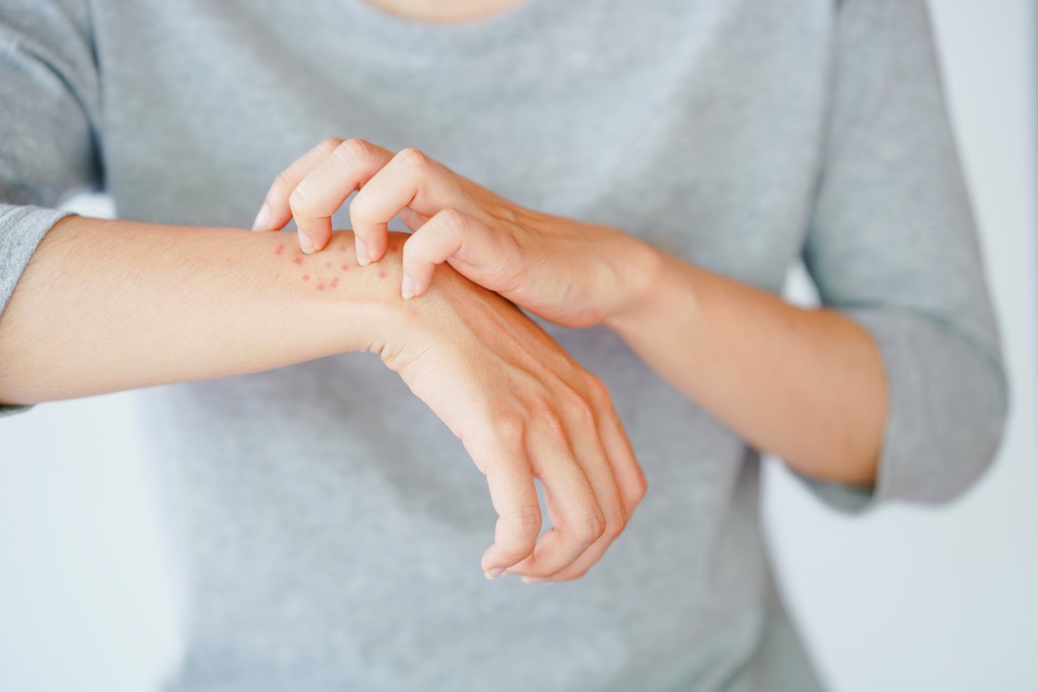 Alergia la nichel (femeie care se scarpina pe mana, bubite rosii, alergie la nichel)