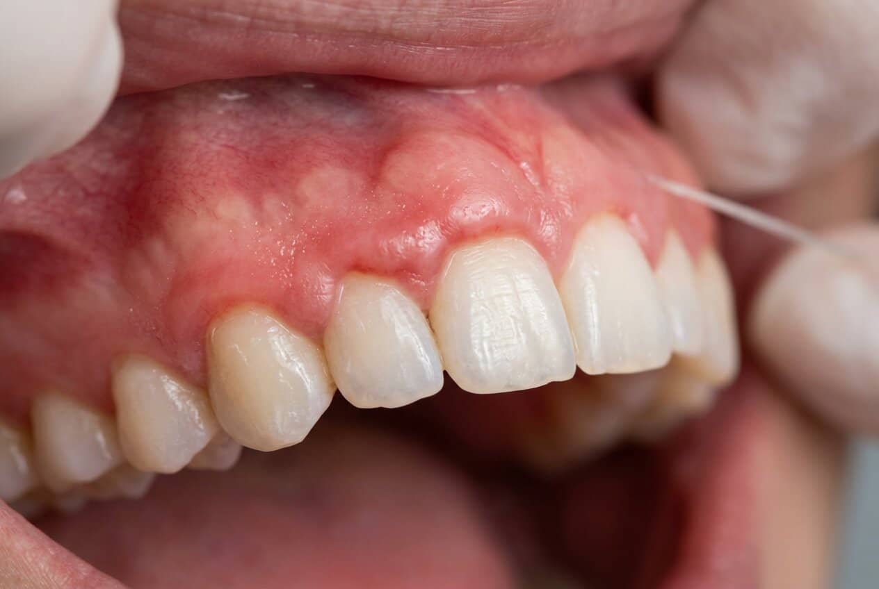 hipertrofie gingivala