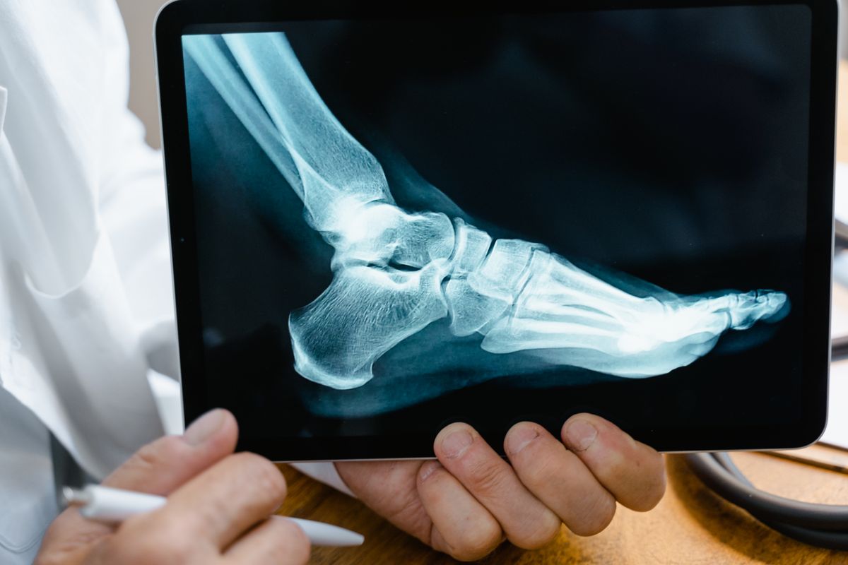 Fractura cominutiva (medic care tine o tableta in mana, radiografia unui picior, pix alb)