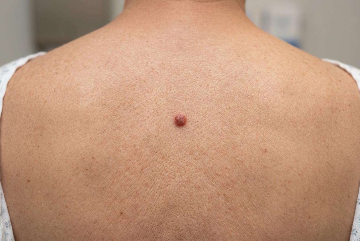 Granulomul tipuri, simptome, diagnostic si optiuni de gestionare
